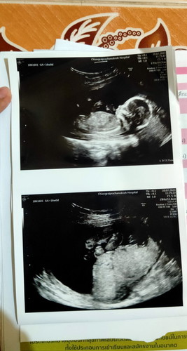 มีใครเห็นเพศลูกบ้างยังคะบ้านนี้17+2ถ่างขาให้ดูเลยจ้าได้ลูกสาวพอรุ้เพศแล้วเริ่มเตรียมของกันรึยังคะ