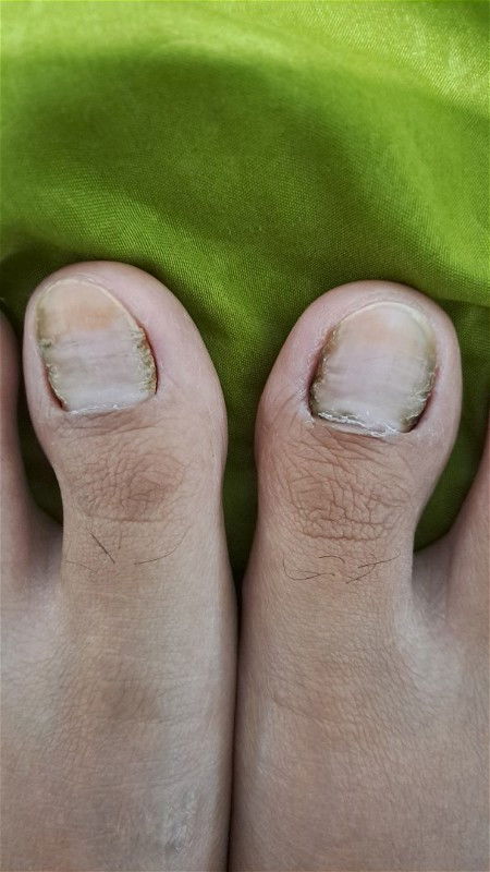 Cara obatin kuku jempol kaki