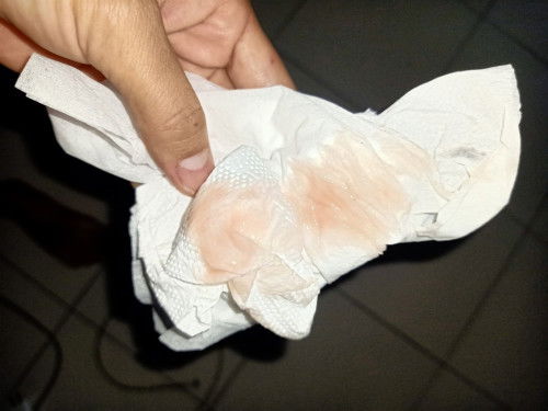 37w+3 มีมูกออกแบบนี้ แต่ไม่มีน้ำเดิน ไม่มีเจ็บท้อง