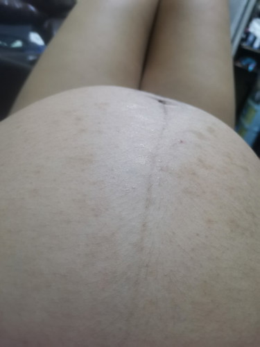 Belly Rash or Stretch Marks?