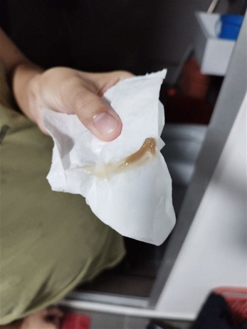 Brownish stcky discahrge