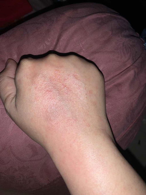 Gatal2 di trimester 2