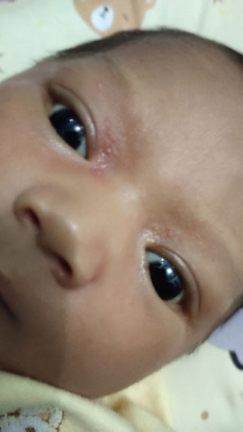 Ini merah2 kenapa yaa bun di muka si kecil. Baru umur 20hari tau-tau gini dr kemarin.