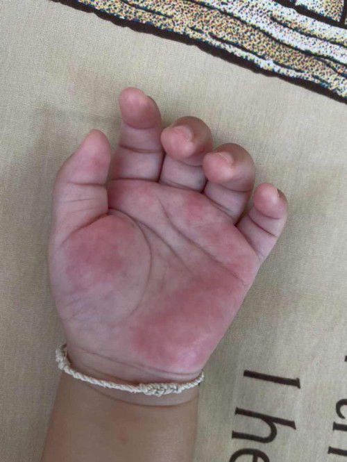 อาการหลังฉีดวัคซีน6เดือน