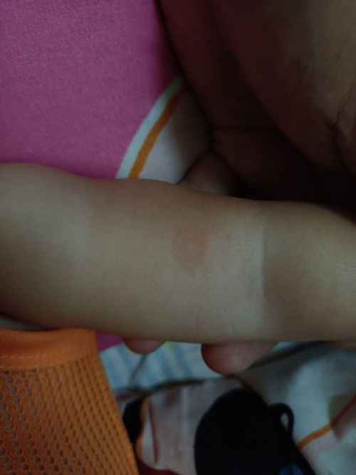 สอบถามหน่อยค่ะผื่นแบบนี้เป็นอะไรค่ะ