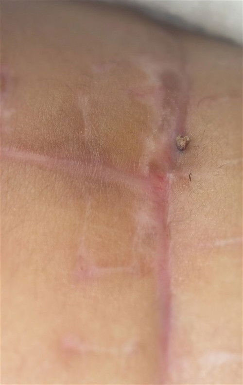 Keluar benang putih setelah operasi