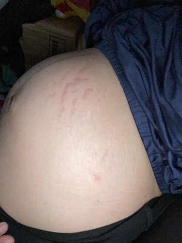 stretch marks