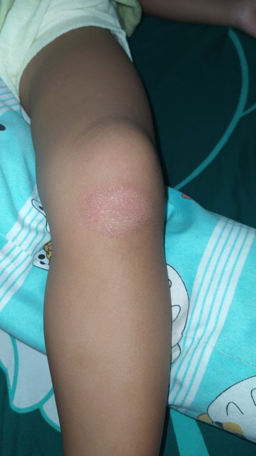 Kulit lutut bayi iritasi?