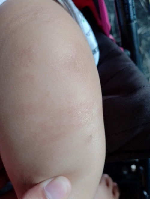 Mga mhie tanong kulang kung ano gamot para Dito ? Dumarami Kasi pati sa Mukha ni baby Meron na Po 🥹