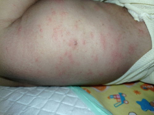 obat gatal bayi 1bulan 20hari apa ya bunda.. udah ke bidan dan klinik masih kyag gini 😭