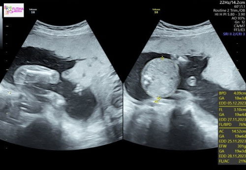 Hasil usg : BPD janin kurang 10 hari