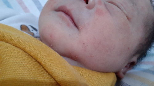 Bintik bintik pada area wajah bayi