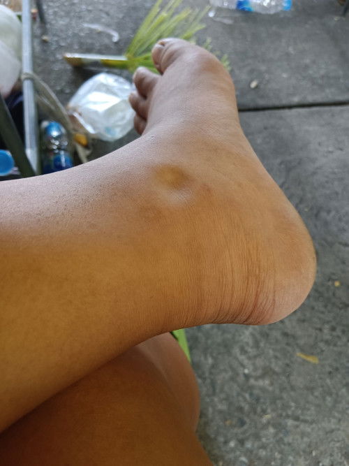 เท้าบวมกดแล้วเป็นแบบนี้