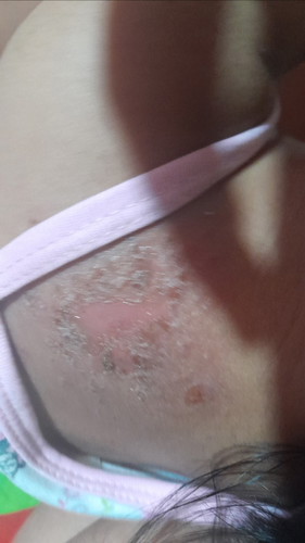 Skin irritation