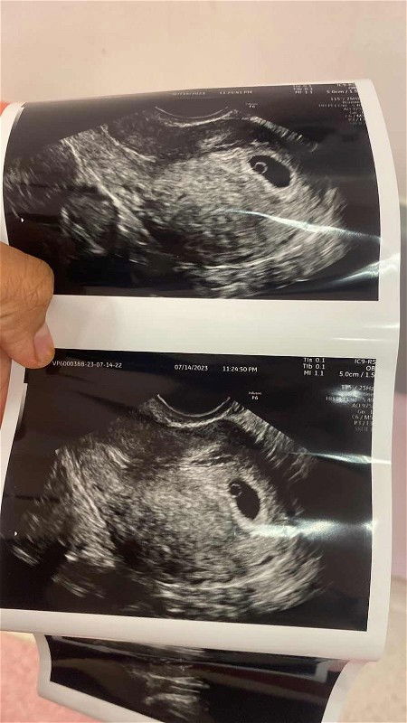 berjaya pregnant after etopik