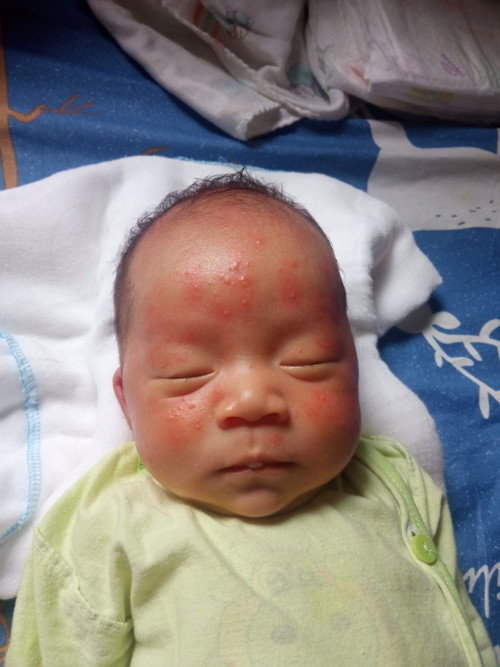 Các mom cho mình hỏi . Bé nhà mình bị vậy mua thuốc bôi không khỏi.