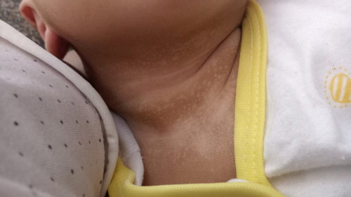 Putih putih di leher bayi