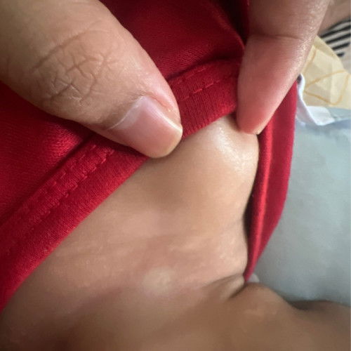 kulit bercak putih pada bayi