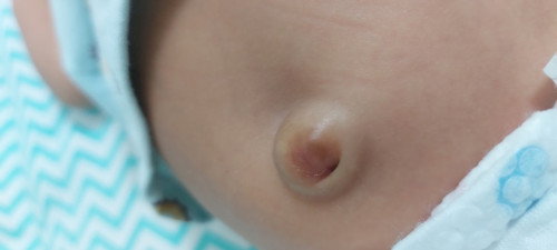 Ano pong sabi sa inyo ng pedia about sa umbillical hernia?