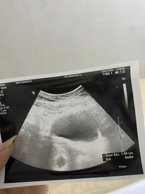 kantung kehamilan tidak bulat