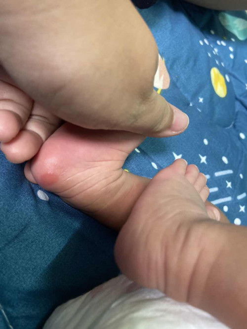 แบบนี้เรียกว่าตุ่มอะไรคะ