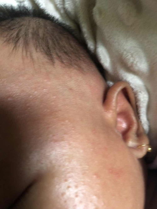 #Newmom..(bintik2 merah di pipi,normal kah?)