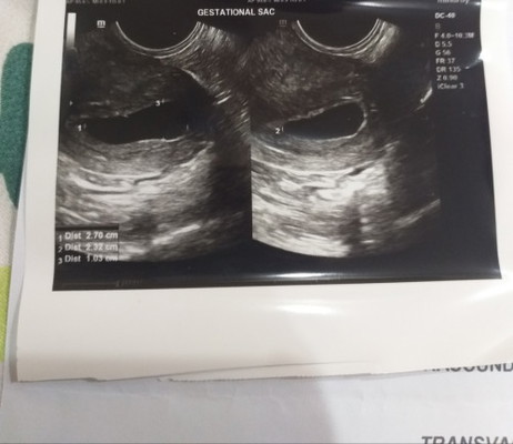 empty gestational sac