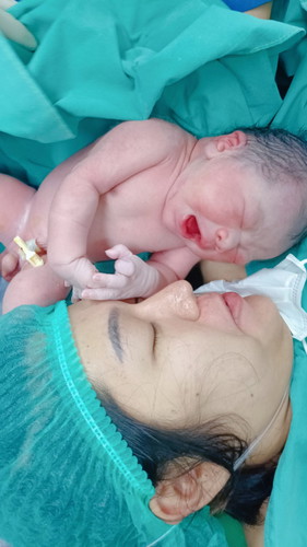 แอบแตกแล้วจร้าแม่ๆ 39+5 ปวดท้องตั้งแต่ตี 1 ถึง 10โมงปากมดลูกก็ไม่เปิด มีมูกเลือด  หมอให้ผ่าด่วนค่ะ