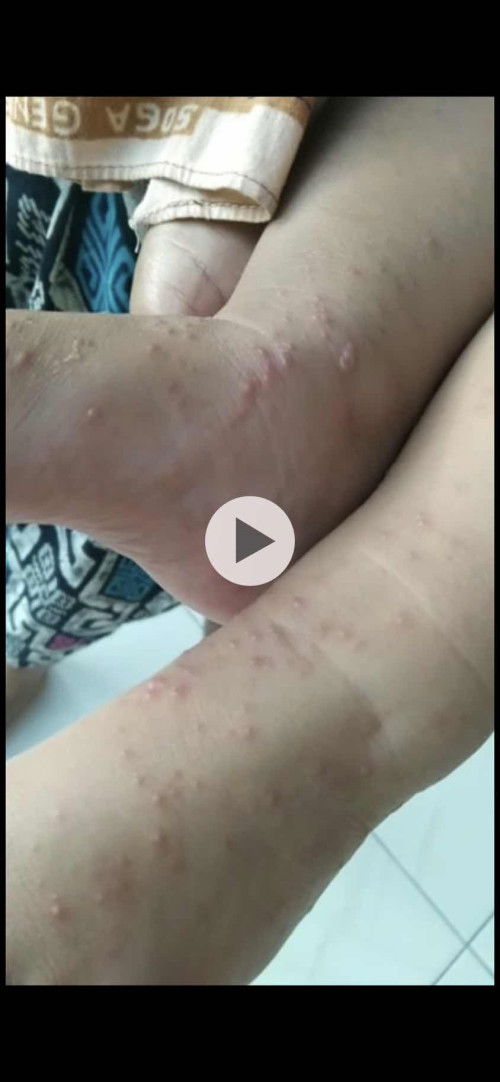 Bintik bintik kecil diseluruh tubuh anak