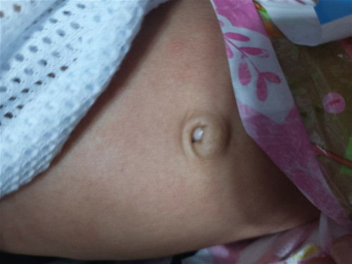 Pusod ni baby / parang may bilog na nakausli sa loob ng pusod niya? | 1 month old bb boy!