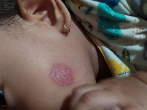 Ruam Merah di Pipi Bayi