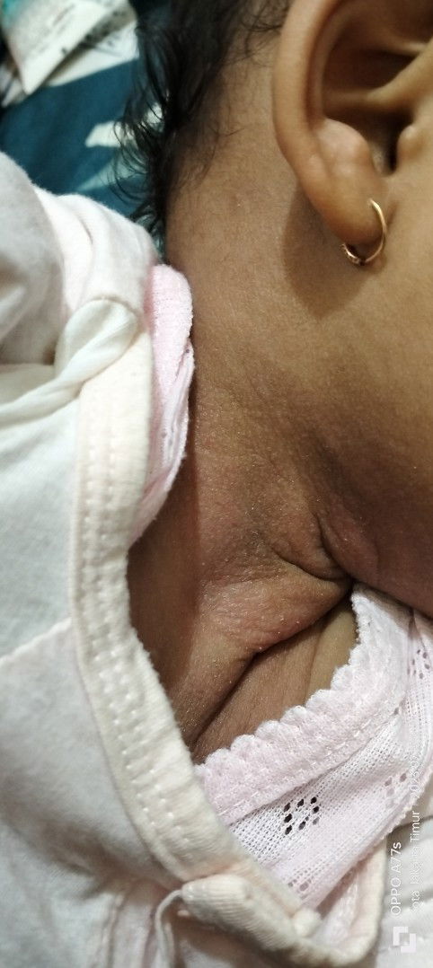 Gatal pda leher bayi