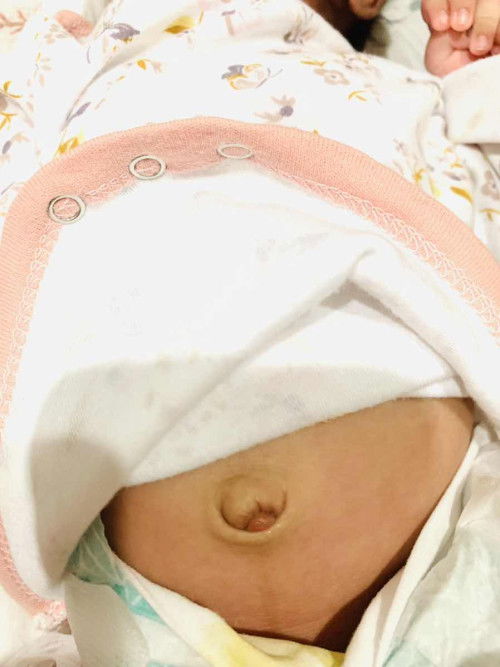 Wet pusod 1 month baby