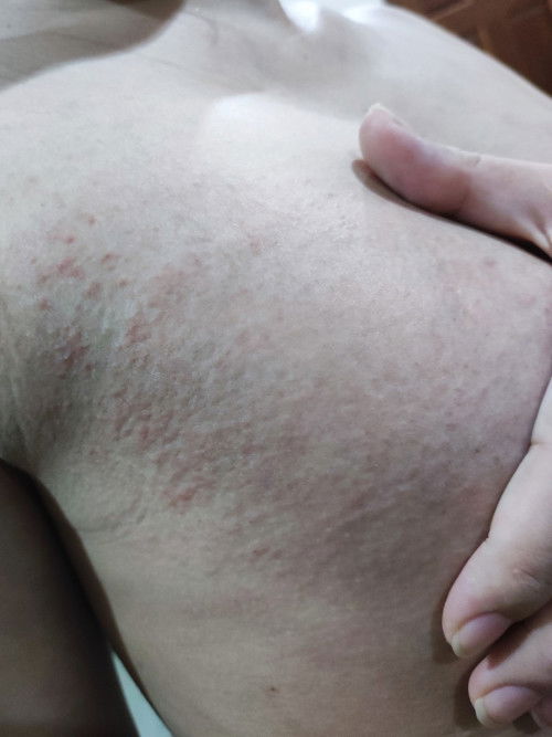 ขอคำแนะนำหน่อยค่ะ มีผื่นคันขึ้นแบบนี้..คือผื่นอะไรคะ