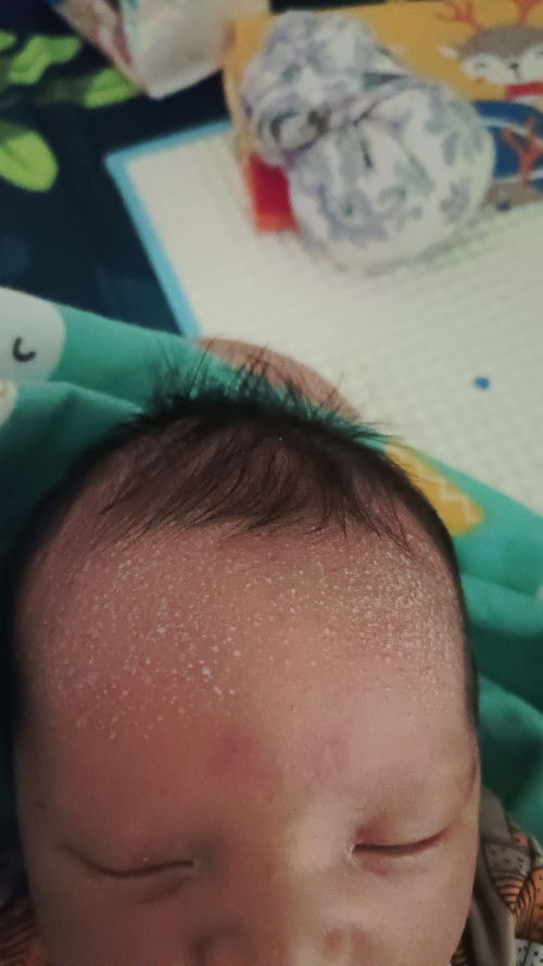 Mohon solusi untuk biang keringat