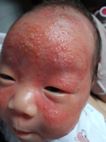 Mua đủ loại thuốc bôi. Đến lá tắm mà Em không đỡ. Có mom nào biết thuốc gì hiệu quả không a.