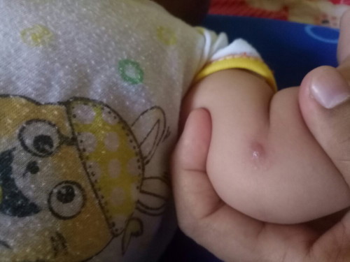 Untuk ilangin bekas kyk di gigit nyamuk kyk gini pake apa y bun, udh seminggu ga ilang² jd kya bisul