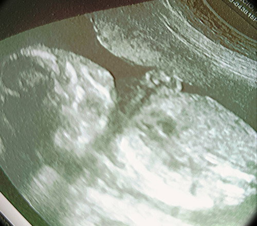 2nd trimester