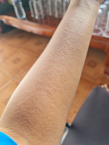 มีใครเป็นผื่นแบบนี้บ้างคะ