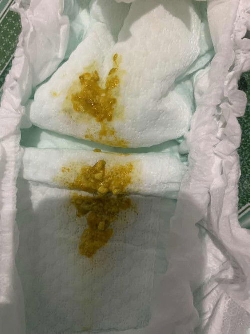 Các mom cho em hỏi bé nhà em đi phân như này có phải bị rối loạn tiêu hoá k ạ?