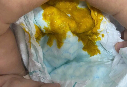 Diarrhea po ba ito?