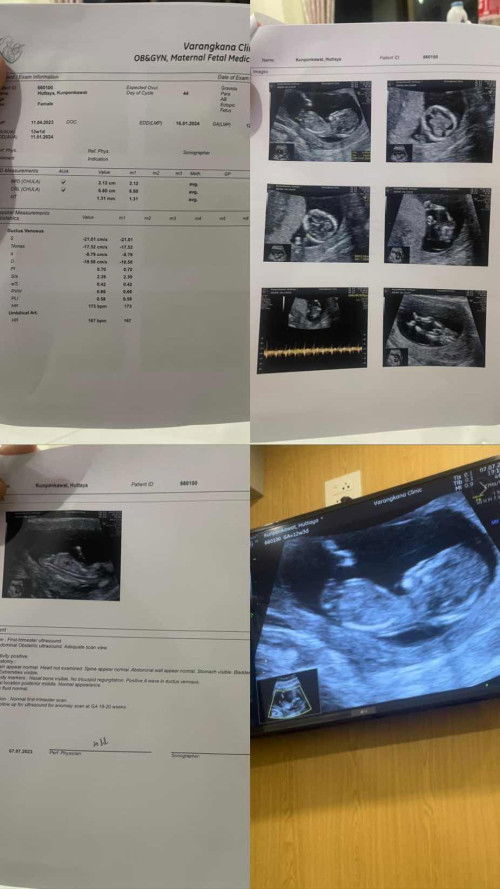 เราตรวจ nipt test  12w