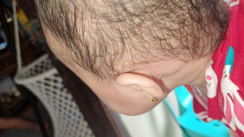 Parang bukol sa likod ng tenga