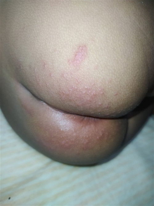 Rashes sa private part