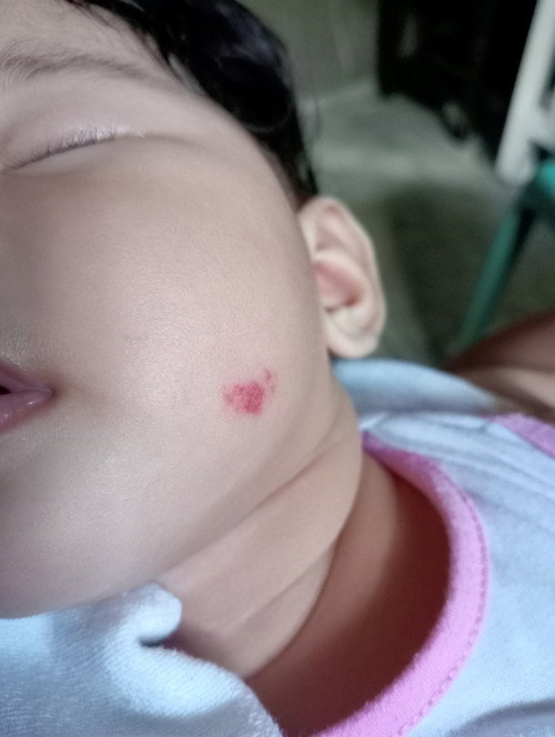 Birthmark na pula
