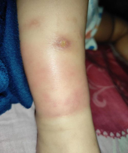 Bintik beair pada kulit bayi