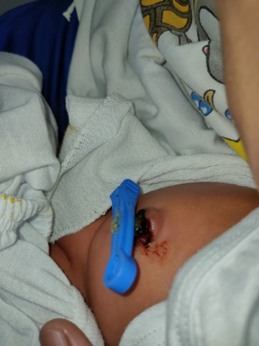 Sign poba ng infection kapag dumudugo pusod ni baby? 10days old papo sya.