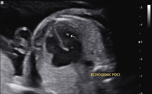 Echogenic foci