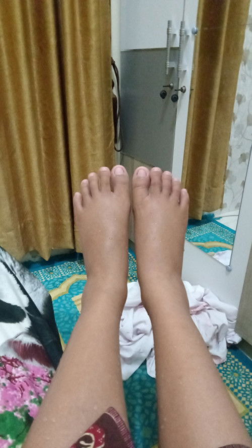 Kaki bengkak bikin gak nyaman