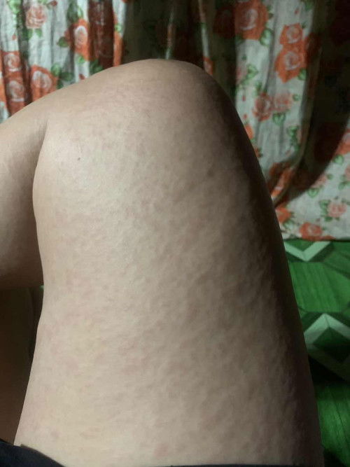 ano po kaya pwede igamot dito sa kati kati buong katawan ko na meron 